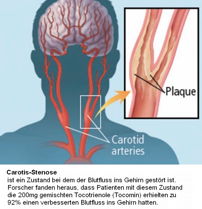 Carotid Stenose